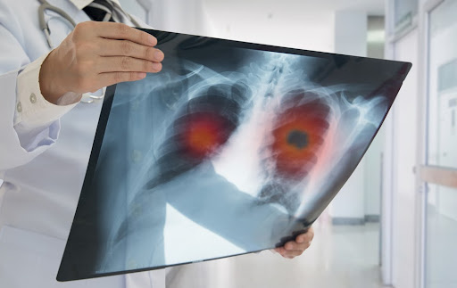 Diagnóstico de tumor pode ser feito por meio de radiografia do tórax. (Fonte: create jobs 51/Shutterstock)
