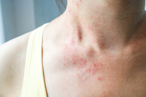 Quais são os sintomas e como tratar alergia de pele? • Summit Saúde Estadão