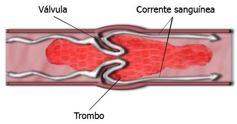 Diagrama da trombose. (Fonte: Wikimedia Commons/Reprodução)