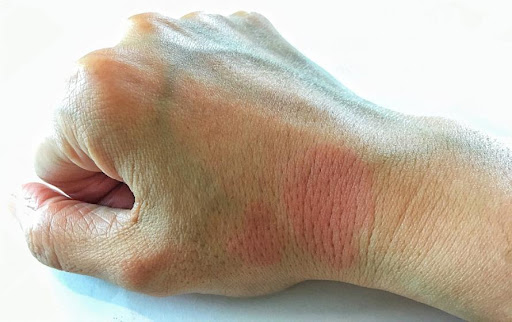 Pacientes com lúpus podem apresentar manchas vermelhas na pele. (Fonte: Secretaria Estadual de Saúde do Rio de Janeiro/Reprodução)