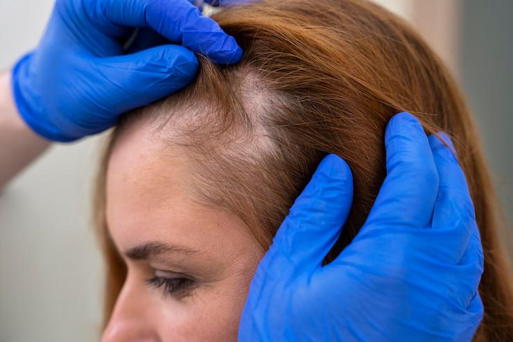 Na alopecia, a queda de cabelo ou pelos é intensa, tornando visíveis o couro cabeludo ou a região da perda de fios. (Fonte: Freepik/Reprodução)