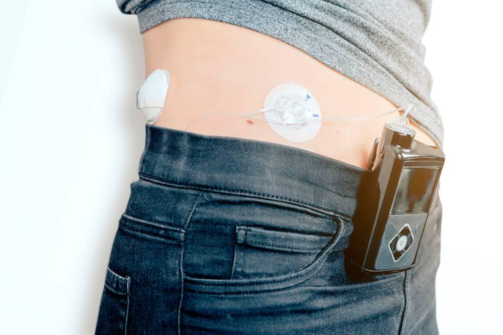 Sensor e bomba de infusão conversam para administração de doses adequadas de insulina.