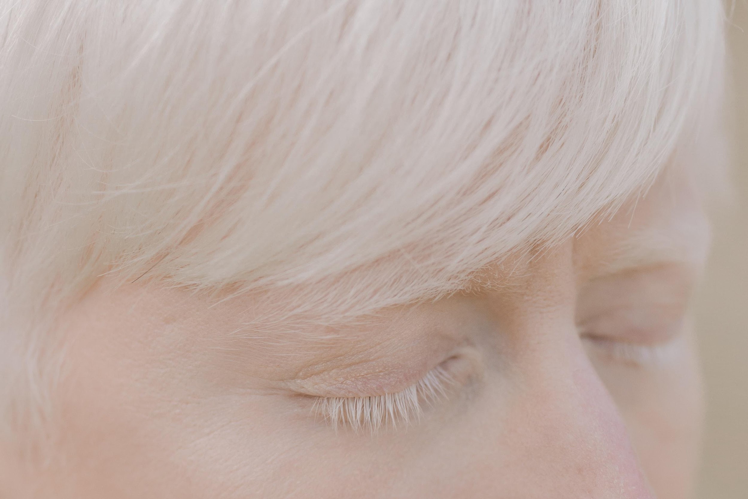 O albinismo pode gerar a despigmentação dos pelos e cabelos de pessoas que convivem com essa mutação genética. (Fonte: Pexels/Reprodução)