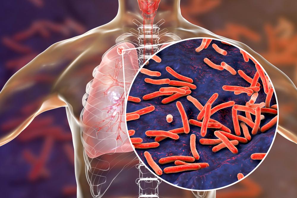 A tuberculose afeta principalmente os pulmões, mas pode chegar a outros órgãos. (Fonte: Shutterstock)