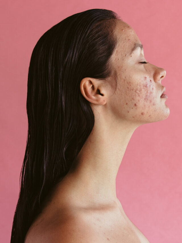 Stress can lead to acne inflammation
