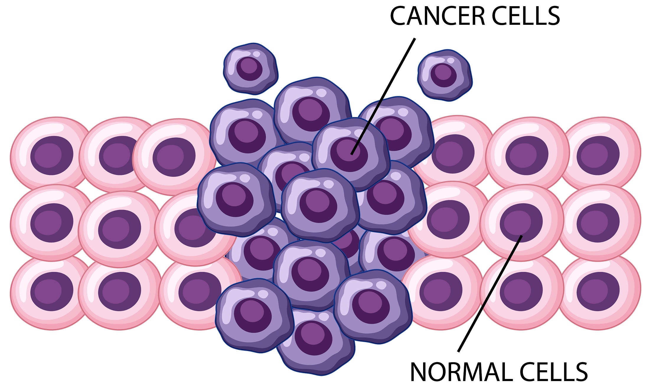 Células cancerígenas se agrupam e formam um tumor 