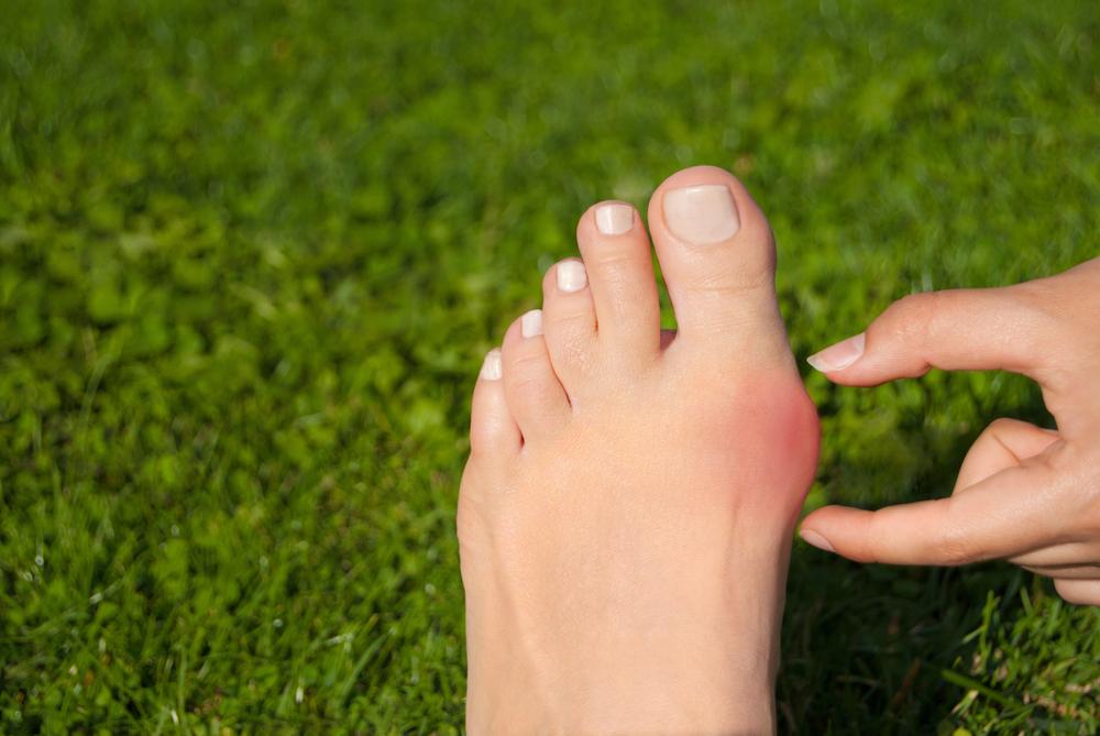 A saliência óssea no dedão do pé pode apresentar tamanhos variados. (Fonte: Shutterstock/Reprodução)