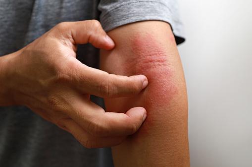 Alterações na função de barreira da pele e disfunção do sistema imunológico também estão envolvidas no desenvolvimento da doença. (Fonte: Getty Images/Reprodução)